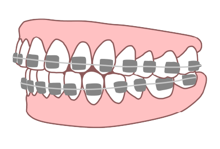 ワイヤー矯正の画像