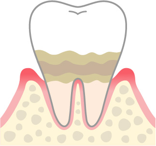 歯周炎（軽度）