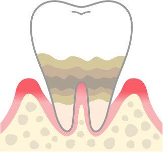 歯周炎（中等度）