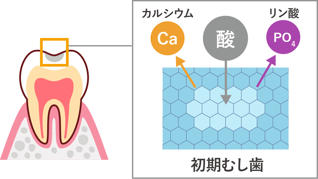 初期むし歯、カルシウム、酸、リン酸