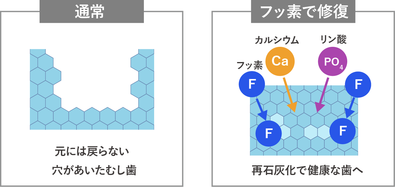 通常：元には戻らない穴が開いたむし歯のイラスト、フッ素で修復：再石灰化で健康な歯へ